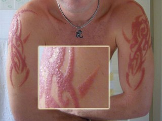 Henna Tattoo Allergic Reaction