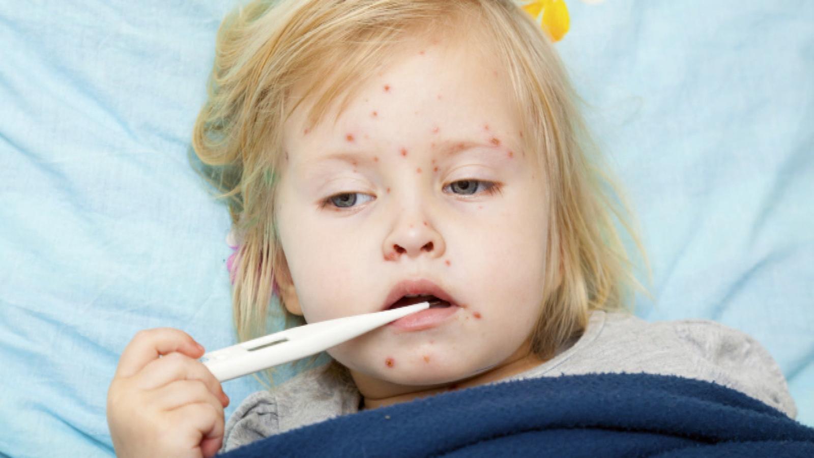 Measles Photos and Images - ABC News