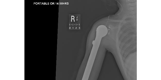 This X Ray Shows The Prosthesis Now That Its In Josalyn Kaldenbergs Arm
